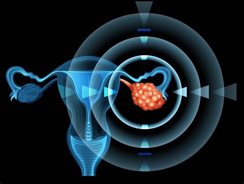 Chist ovarian hemoragic: Simptome, factori de risc si diagnostic